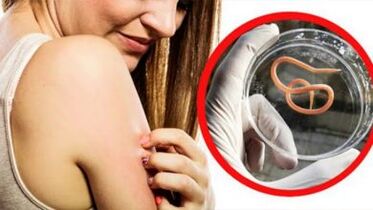 Una erupción en el cuerpo es un signo de infección por helmintos.