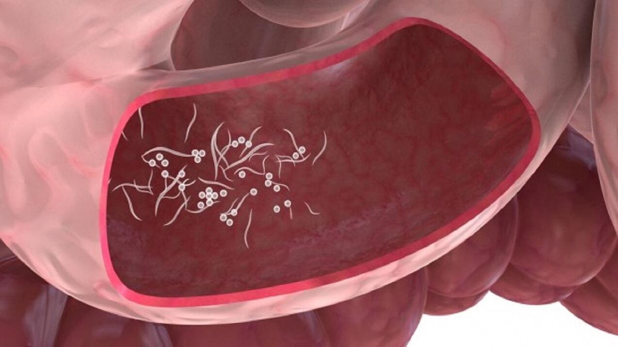 Parásitos Giardia en el hígado.